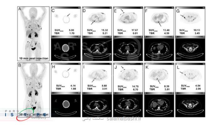 تصویربرداری پت اسکن زودهنگام با رادیوداروی Ga-68-FAP-2286